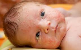 La alergia en la piel puede surgir por diferentes causas. Tu Bebe Tiene Sarpullido En La Cara Conoce Las Posibles Razones