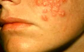 hiv rash images symptoms location