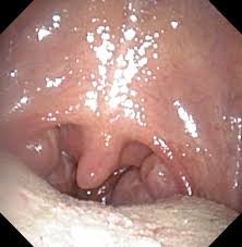 having your tonsils removed ent