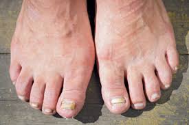 fungal nail infections healthify