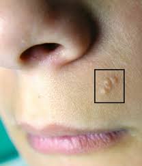 pre sebaceous hyperplasia with
