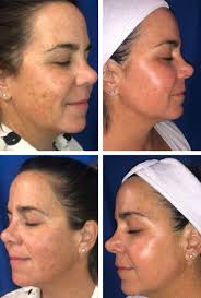 Bbl Corrective Therapy Face It Botox Bar Fort Myers Botox