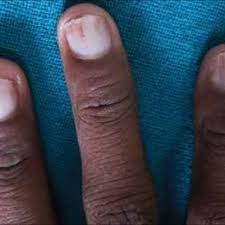 nail bed telangiectasia in a patient
