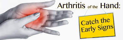 Early signs of arthritis in the fingers. Arthritis Of The Hand In Louisiana Catch The Early Signs Anonpr