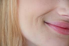 dry skin around mouth symptoms causes