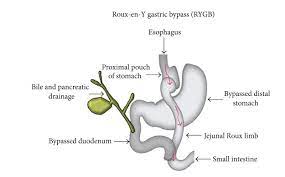 gastric byp