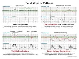 Fetal Monitoring Child Nursing Newborn Nursing Ob Nursing