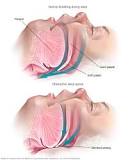 Image result for icd 9 code for sleep disordered breathing