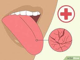 13 ways to soothe a burnt tongue wikihow