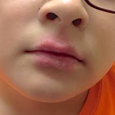 psoriasis treatment dr dan s lip