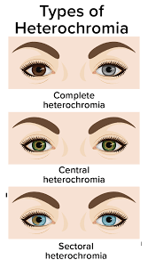 heterochromia diffe colored eyes