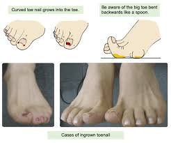 ingrown toenail kasahara foot care