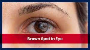 the causes of brown spots in eyes