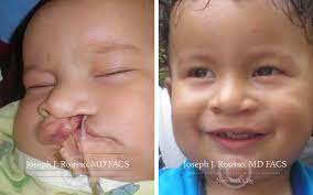 cleft lip palate surgery for children
