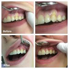 gum grafts ottawa periodontal surgery