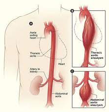 aortic aneurysm physiopedia