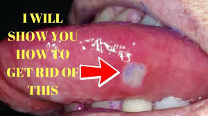 tongue canker sores in mouth treatment