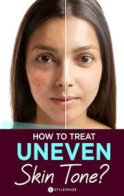 Uneven skin can be temporary or permanent, and it may result from don't forget to moisturize all of your skin — not just your face. Uneven Skin Tone Tips To Get Rid Of It Naturally Uneven Skin Tone Face Uneven Skin Tone Remedies Uneven Skin