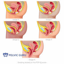 pelvic pain during menopause dr