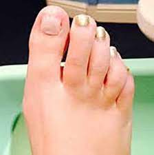 toenail regrowth after a fungal