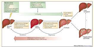 How is cirrhosis of the liver diagnosed? Schematic Representation Of Course Of Chronic Liver Diseases Etiology Download Scientific Diagram