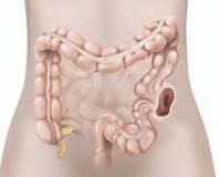 Image result for icd 9 code for colostomy takedown