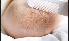 cradle cap causes and treatment pers
