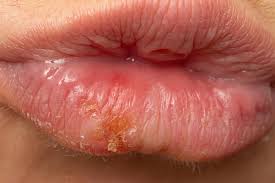macro of woman s lips with cold sores