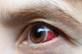 eye infections prevention risks