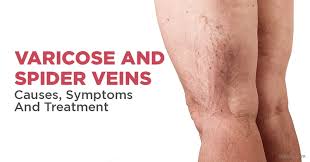 what are varicose and spider veins