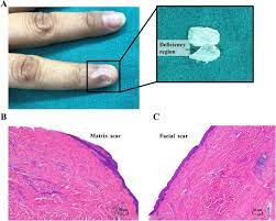 nail matrix scars that result in nail
