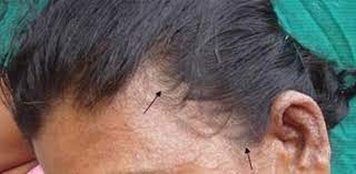 This type of hair loss is called these treatments commonly use antifungal agents to address a potential fungal infection from. Do Fungal Infections Cause Hair Loss Hairguard