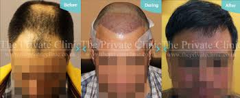 Maybe you would like to learn more about one of these? Hair Growth After Hair Transplant After Follicular Transfer Fue Hair Transplant