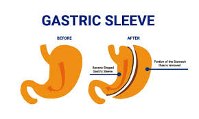 gastric sleeve surgery jl prado