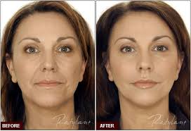 how much do dermal fillers cost