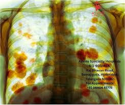 lung cancer nsclc types treatments