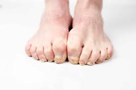 causes of curled toenails feet first