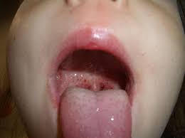 fever and sore throat in a child