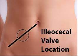 open ileocecal valve triad of health