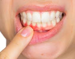 what causes receding gums arch city