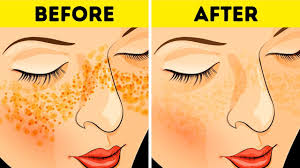 how to get rid of acne scars in just 3