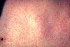 Image result for measles rash distribution