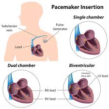 It also contains a computer that tracks your heart rate and rhythm. Biventricular Pacemaker Implantation Procedure Cape Town Cardiac Resynchronization Therapy