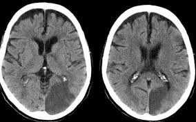 Dr Balaji Anvekar FRCR: Ischemic stroke and Vascular territories of Brain