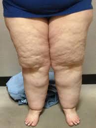 lipedema painful fat disorder