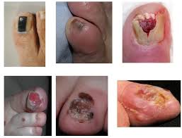melanoma of the foot and nail unit