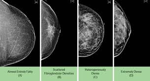 Don't just look for breast lumps. Secondary Screening With Abus Improves Cancer Detection In Dense Breasts North Kansas City Hospital North Kansas City Mo