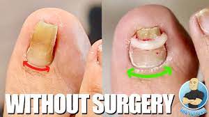 severe ingrown toenail treatment