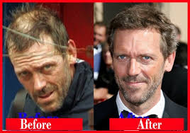 You asked us, so here is our article about celebrity plastic surgery disasters gone wrong with before after photos. Famous Celebrity Hair Transplants Ak Clinics