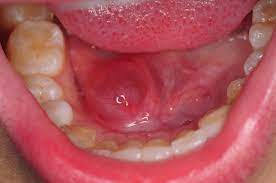 ranula under the tongue